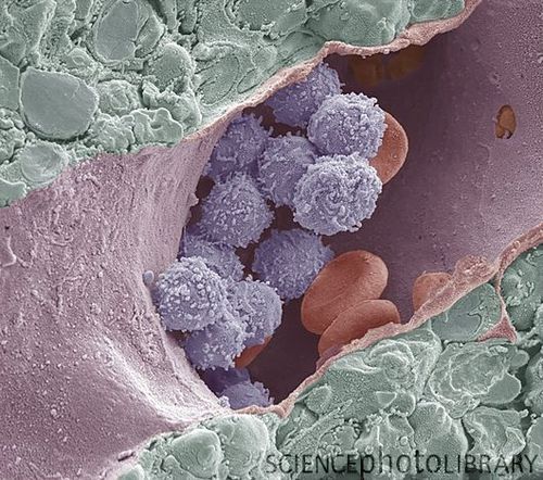 Bone marrow, coloured scanning electron micrograph (SEM). This freeze-fracture has revealed the cavity (lumen) of a large venous sinus (pink), which contains mature blood cells (red), and developing white blood cells (blue). Either side of the sinus are the haemopoetic foci of the marrow (green). Magnification: x3000 when printed at 10 centimetres across | Steve Gschmeissner